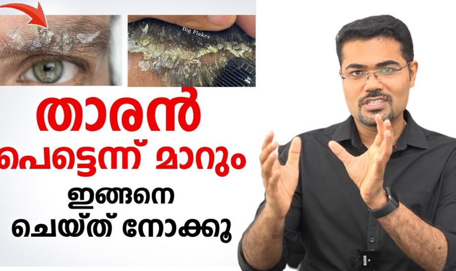 നിങ്ങളുടെ താരൻ പ്രശ്നങ്ങളെ ഇനി മറന്നേക്കൂ, താരൻ പൂർണ്ണമായും മാറ്റിയെടുക്കാം