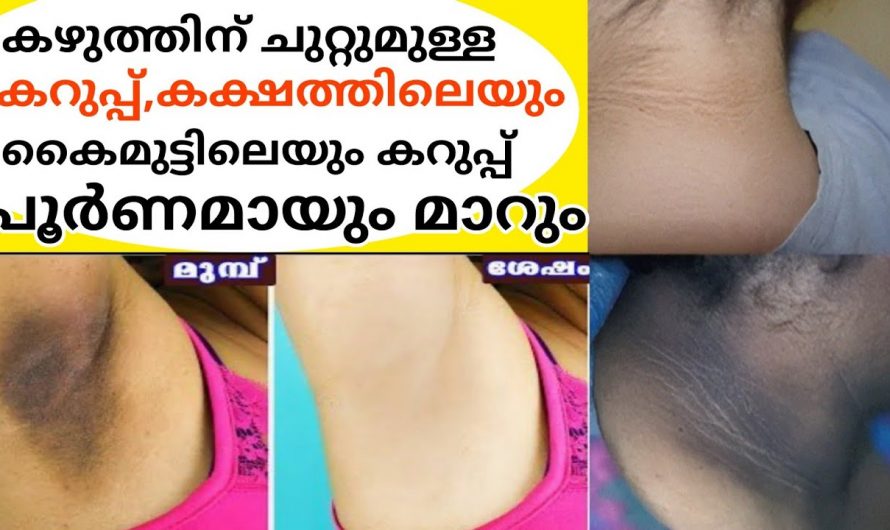 കക്ഷത്തിലും കഴുത്തിലുള്ള കറുപ്പ് ഇനി നിസ്സാരമായി മാറ്റം. നിങ്ങൾക്കും തയ്യാറാകാം ഈ മാജിക് പാക്ക്.