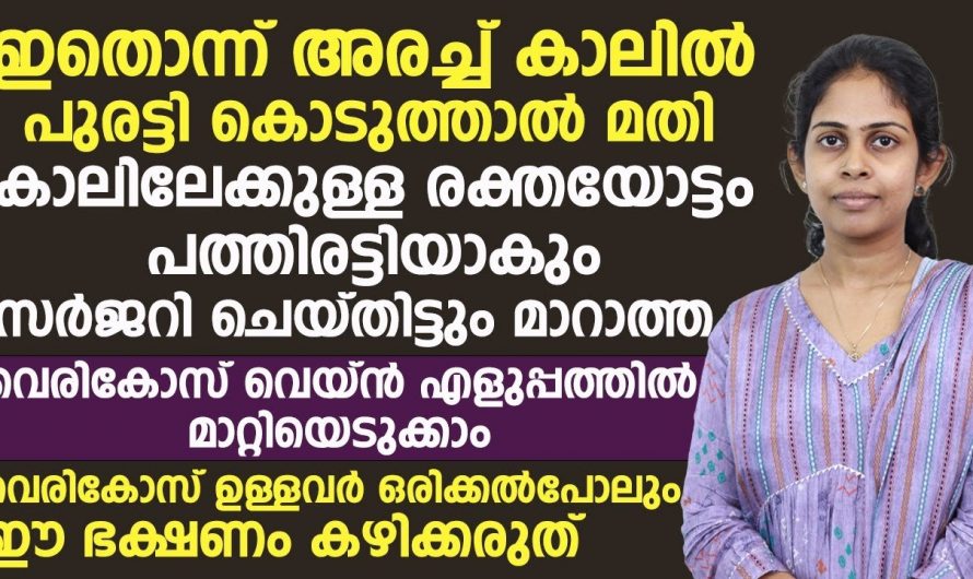 നിങ്ങളുടെ വെരിക്കോസ് മാറാൻ ഇനി ഒരു സർജറിയും വേണ്ട. വെരിക്കോസ് പ്രശ്നങ്ങളെ എളുപ്പത്തിൽ പരിഹരിക്കാം.