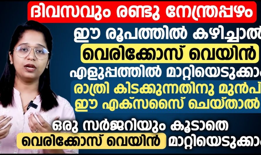 രണ്ടു നേന്ത്രപ്പഴവും ഈ വ്യായാമവും മതി എത്ര വലിയ വെരികോസും മാറും.