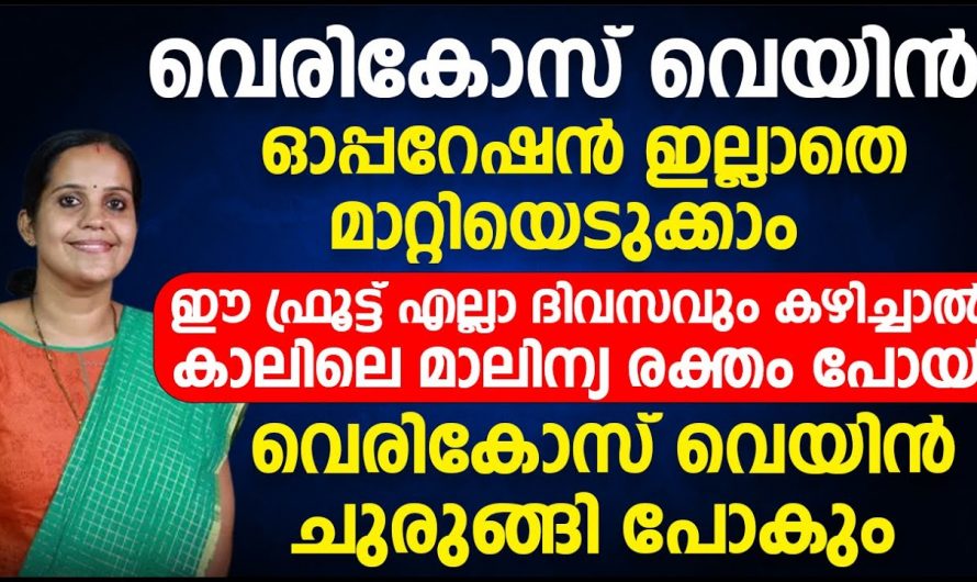 ഒരു സർജറിയും വേണ്ട വെരിക്കോസ് ഇനി സിമ്പിൾ ആയി മാറ്റാം.