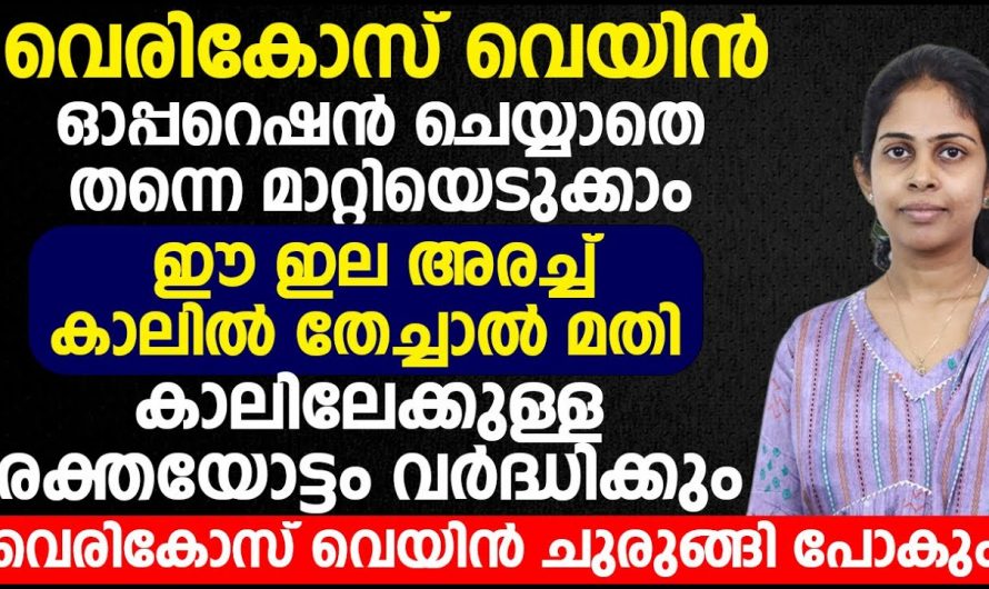 എത്ര കടുത്ത വെരിക്കോസും മാറും, ഈ ഇല ഇങ്ങനെ ഉപയോഗിക്കു.