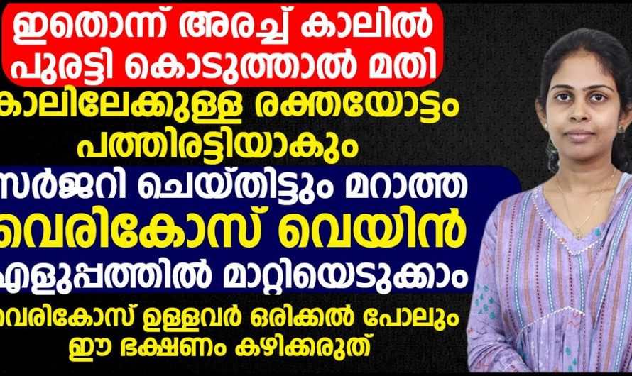 നിങ്ങളുടെ കാലുകളിൽ വെരിക്കോസ് വെയിൻ തടിച്ചു വരുന്നുണ്ടോ. ഇത് അല്പം അരചിട്ടാൽ മതി.