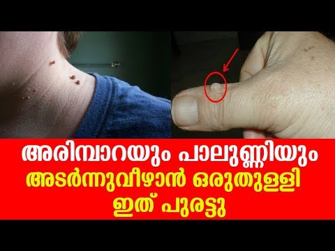 ഒറ്റ ദിവസം കൊണ്ട് അരിമ്പാറയും പാലുണ്ണിയും കൊഴിഞ്ഞു വീഴും.