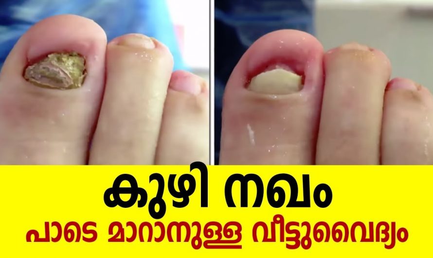 പുഴു കേടുവന്ന നഖം ഇനി മറന്നേക്ക്. നിങ്ങളുടെ അടുക്കളയിൽ ഉണ്ട് ഇതിനുള്ള പരിഹാരം.