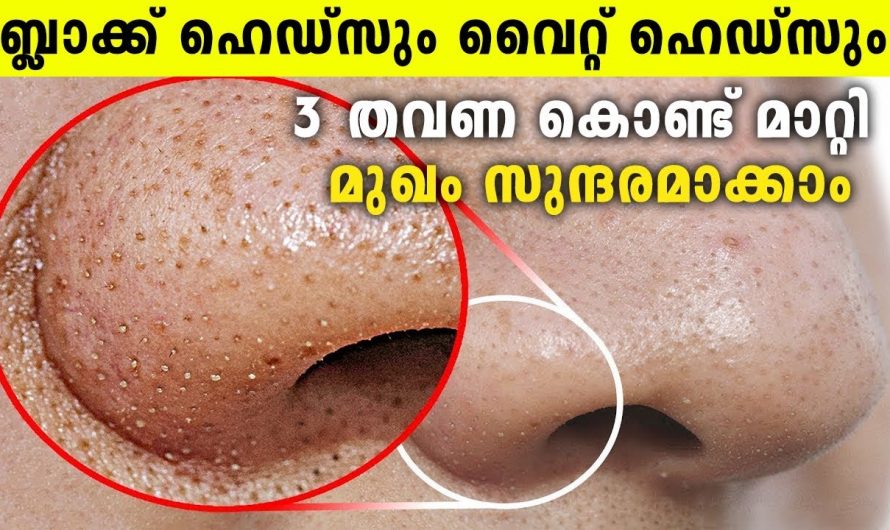 ബ്ലാക്ക് ഹെഡ്സും, വൈറ്റ് ഹെഡ്സും നിറഞ്ഞു മൂക്ക് മറഞ്ഞൊ, ഇനി കണ്ണാടി പോലെ തിളങ്ങുന്ന മുഖം നിങ്ങൾക്കും സ്വന്തം.