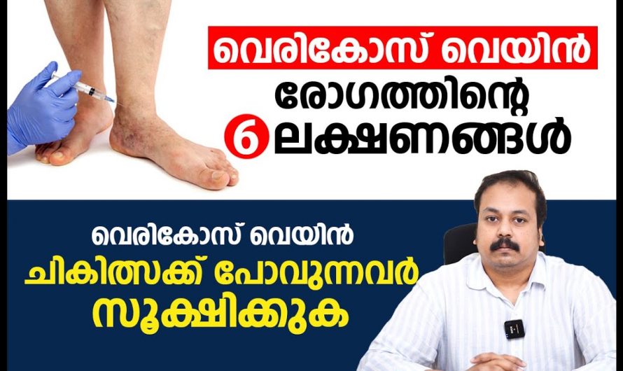 ഒരു സർജറി ചെയ്യും മുൻപ് വെരിക്കോസിനെ കുറിച്ച് ഈ കാര്യങ്ങൾ  അറിഞ്ഞിരിക്കണം