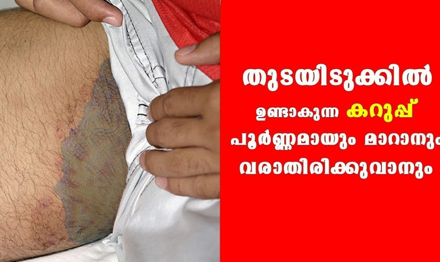 സ്ത്രീകൾ പറയാൻ മടിക്കുന്ന ഈ കറുപ്പിന് മാറ്റാൻ ഇനി മാർഗ്ഗമുണ്ട്