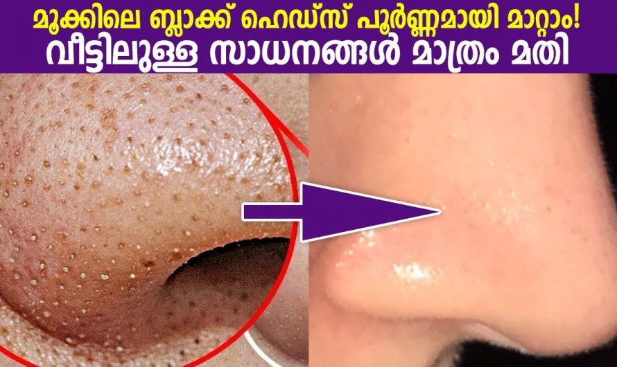 10 ദിവസം മതി പത്തു മിനിറ്റ് കൊണ്ട് എത്ര വലിയ ബ്ലാക്ക് ഹെഡ്സും മാറും