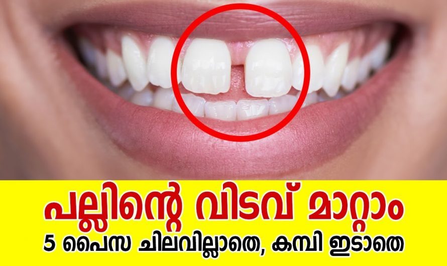 പല്ലിന്റെ ഈ വിടവ് നിങ്ങളെ നാണം കെടുത്തുന്നുണ്ടോ ഒരു രൂപ പോലും ചെലവാക്കേണ്ട മാറ്റം ഈസിയായി
