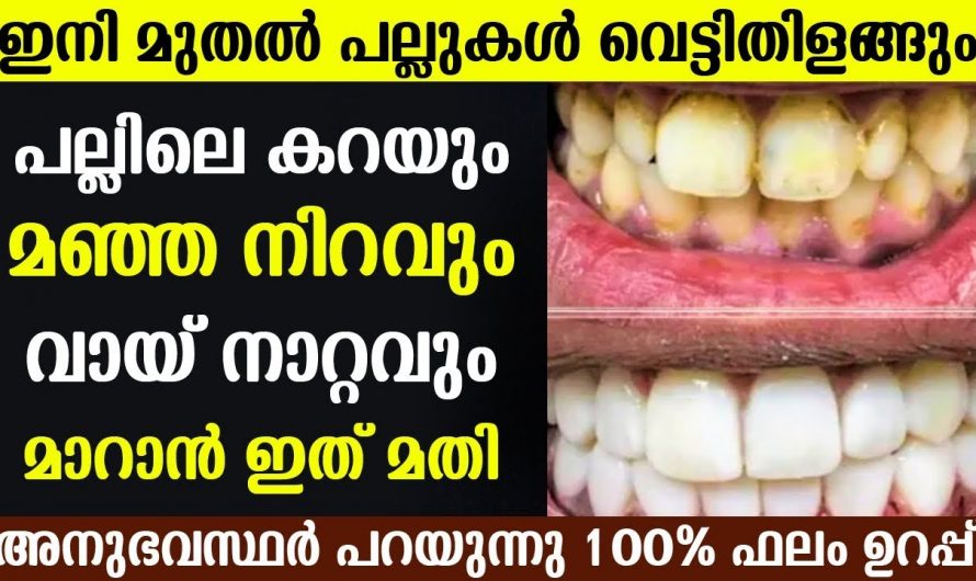 പല്ല് പുളിക്കുന്നുണ്ടോ പല്ലിൽ കറപിടിക്കുന്നുണ്ടോ മാറ്റാൻ ഒരു എളുപ്പ വഴിയുണ്ട്