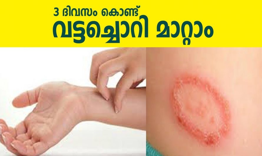 പാടു പോലും അവശേഷിക്കാതെ വട്ടച്ചൊറി മാറ്റിയെടുക്കാൻ ഇനി എന്തെളുപ്പം
