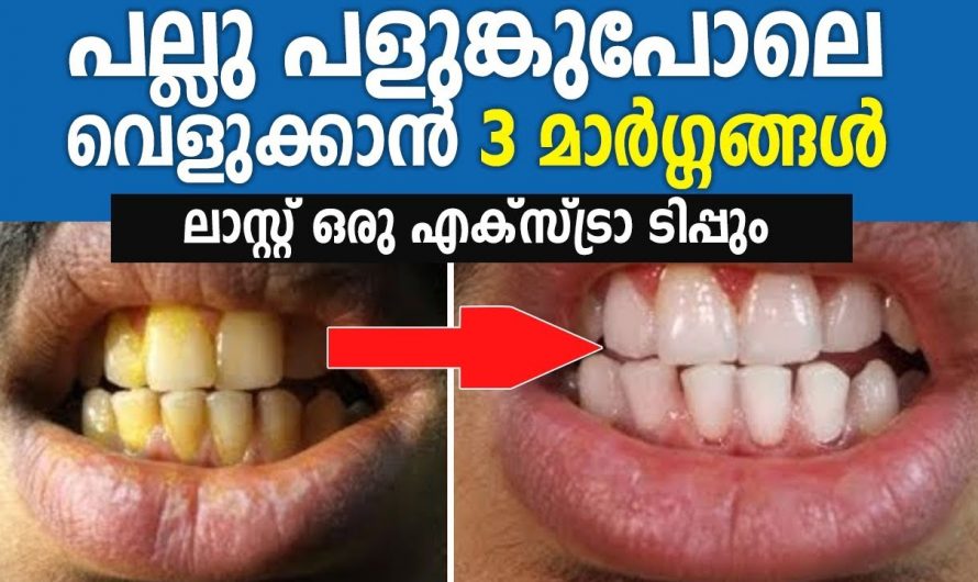 മുല്ലമൊട്ട് പോലെ നിരയും നിറവുമൊത്ത പല്ലുകൾ ഇനി നിങ്ങൾക്കും സ്വന്തമാക്കാം