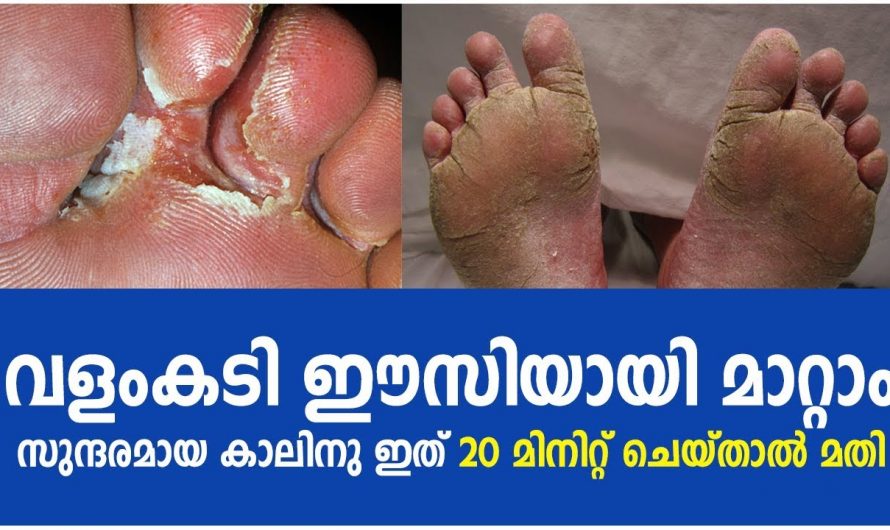 ഏത് മാറാത്ത വളം കടിയും ഇനി ഇതുകൊണ്ട് ശമിക്കും