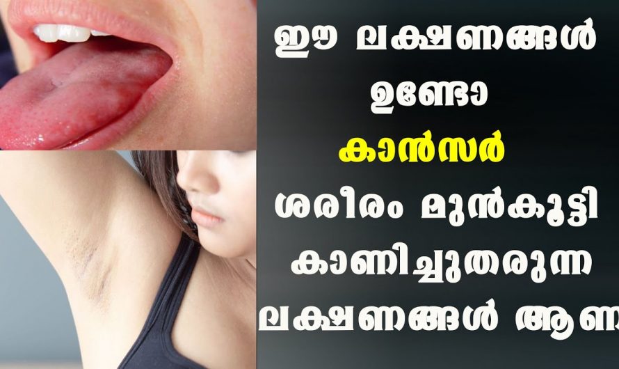 രണ്ടാഴ്ച കൂടുതൽ ഈ ലക്ഷണം കണ്ടാൽ ഉറപ്പിക്കാം ക്യാൻസർ ആണ്