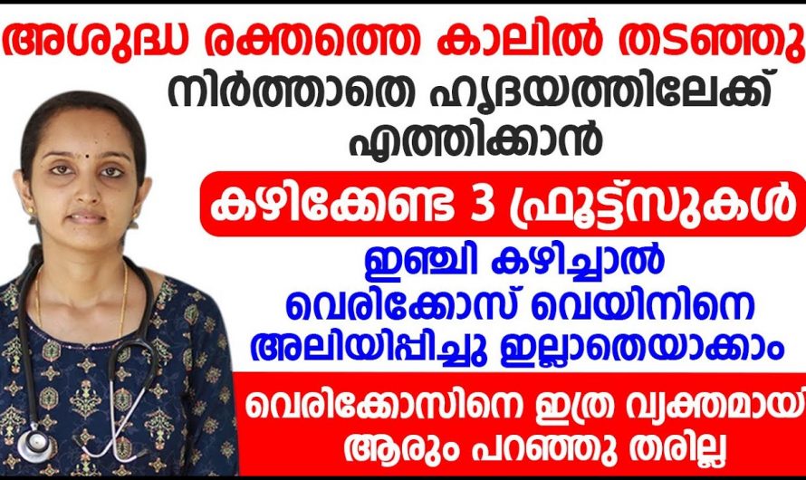 നിങ്ങൾക്ക് വെരിക്കോസ് ഉണ്ടോ, സർജറി ചെയ്തിട്ട് മാത്രം കാര്യമില്ല