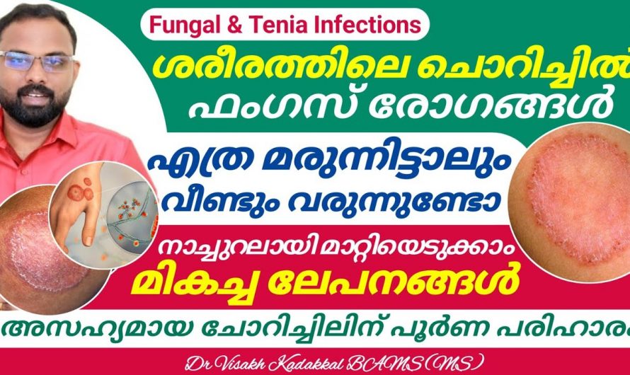 അസഹനീയമായ ചൊറിച്ചിൽ മൂലം  ബുദ്ധിമുട്ടിയോ