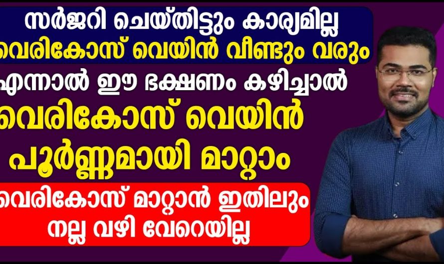 തീർച്ചയായും നിങ്ങൾ കഴിക്കുന്ന ഈ ഭക്ഷണമാണ് വെരിക്കോസിനും കാരണമാകുന്നത്