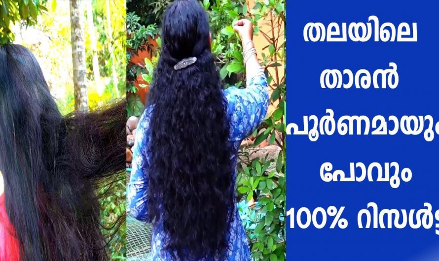 100% താരൻ പോകുമെന്നത് ഗ്യാരണ്ടിയാണ്