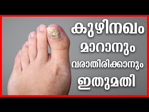 കുഴിനഖം വരാതിരിക്കാൻ ഇത് ഉറപ്പായും സഹായിക്കും